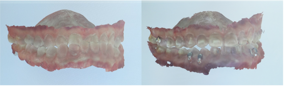 Clinicians take 3D oral scans to track patients’ progress. Scans of Foreman’s teeth before (left) and after (right) one year of clear aligner therapy show improvement in her posterior open bite and underbite.