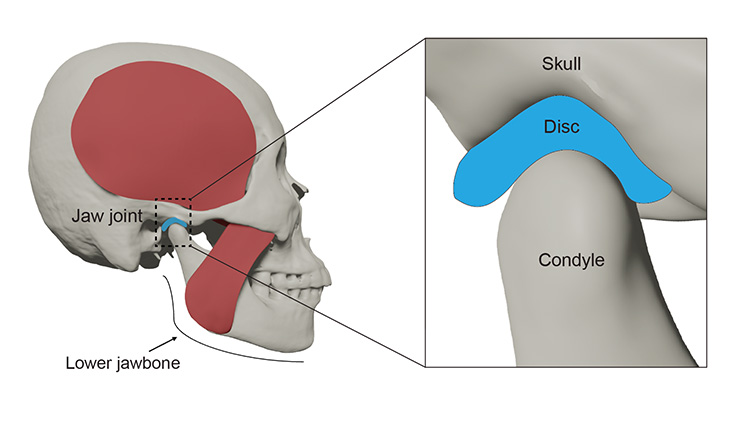 The researchers found that a smaller or flatter condyle, the rounded end of the lower jawbone that forms part of the jaw joint, is linked to TMD risk.