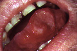 hiv tongue