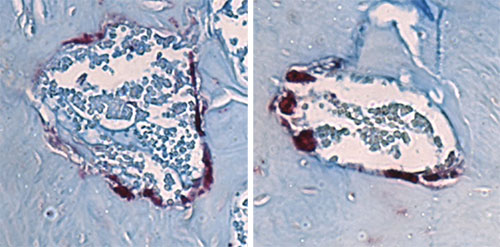 Bone-degrading cells (maroon) in the jawbone marrow of mice lacking microbes (left) are smaller in size than those from mice with a single type of gut microbe (right) that is associated with bone loss from the jaw. 
