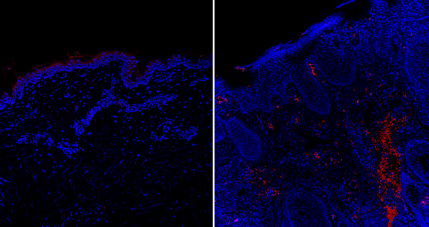 Compared to healthy human skin (left), skin from people with psoriasis had elevated levels of the cytokine oncostatin M (red), which was found to intensify itch responses in mice. 