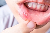 Herpes deals inside mouth