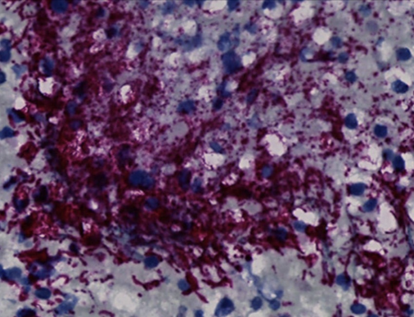 Fusobacterium nucleatum bacteria (purple) in a human colorectal cancer tumor. 