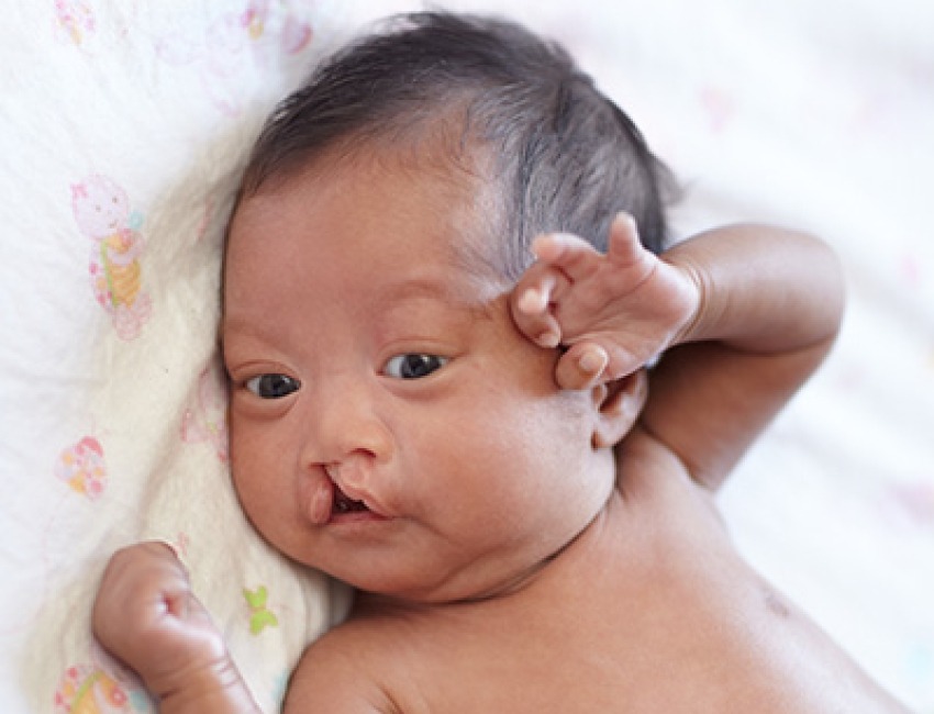 A baby with cleft palate