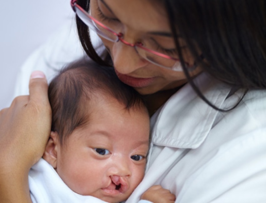 Una enfermera sostiene a un bebé con paladar hendido.