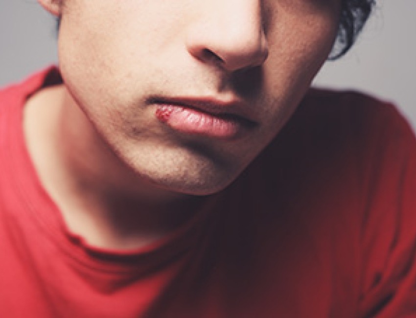 Young man with cold sore on his lip.