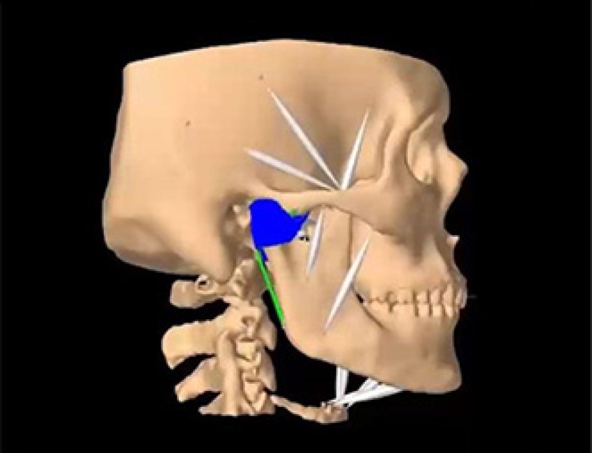 Computer model of a skull and temporomandibular joint.