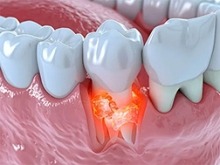 A 3D rendering of teeth and gum with the root of a tooth highlighted in red, indicating gum disease.