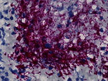 Fusobacterium nucleatum bacteria (purple) in a human colorectal cancer tumor.Fred Hutchinson Cancer Center